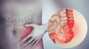 Syndrome du colon irritable et Acupuncture