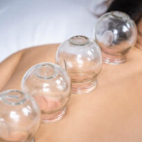 Ventouses/ cupping therapy